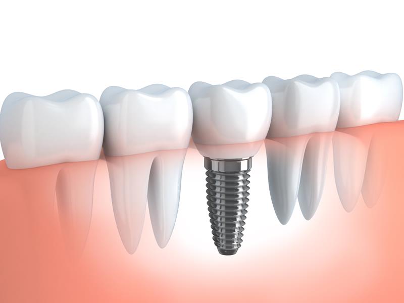 Dental Implants Anaheim, CA