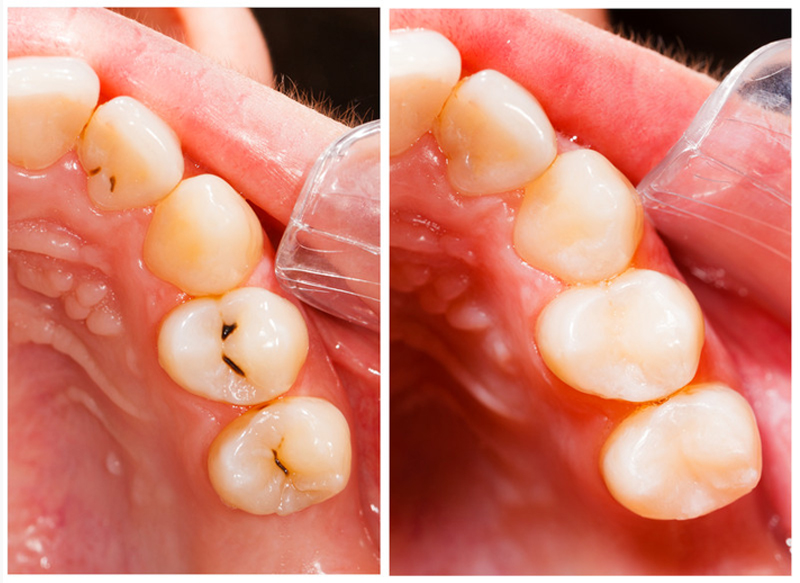 Fillings Anaheim, CA