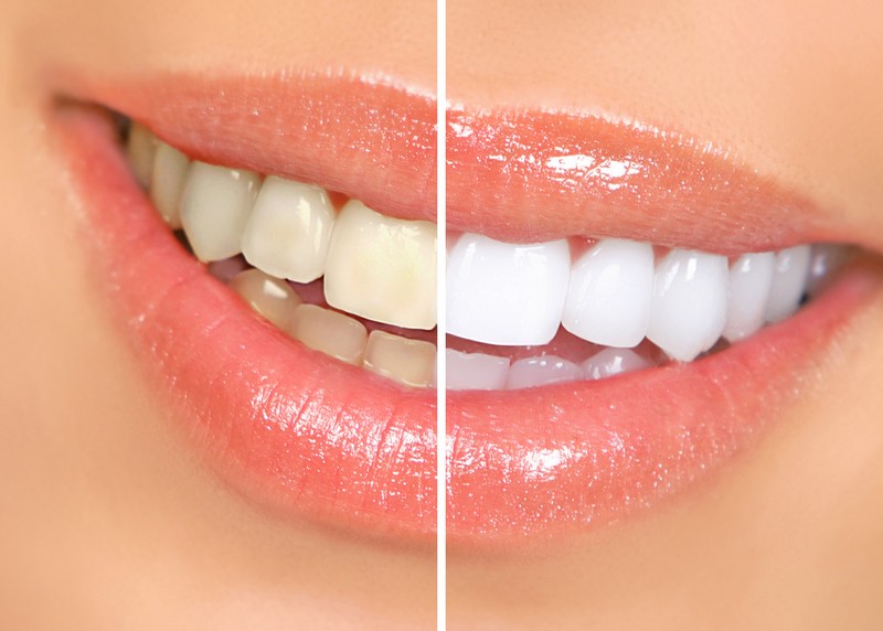 Teeth Whitening Anaheim, CA