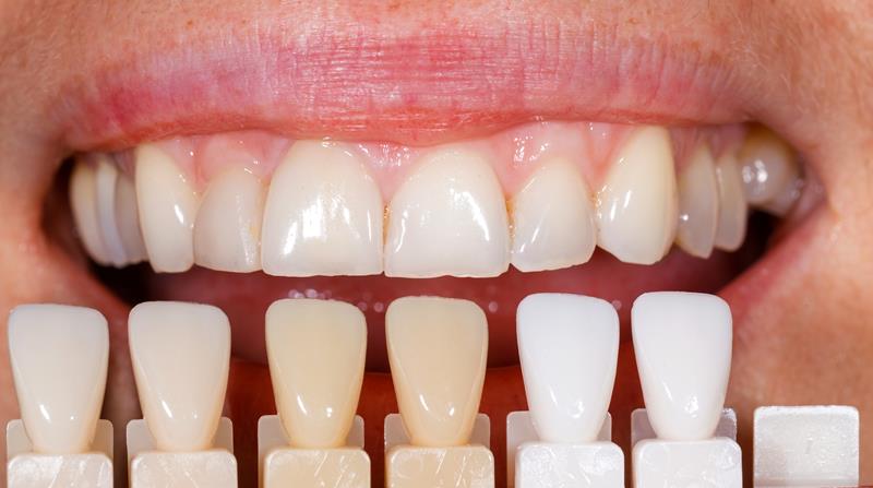 Veneers Anaheim, CA